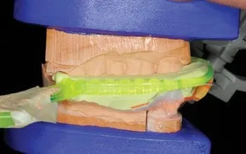 5 articulator step 4