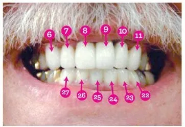 2-1 teeth example photo
