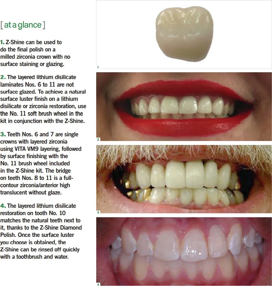 at-a-glance Achieve a Beautiful Smile Using Polishing for Final Touches